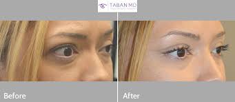 We did not find results for: Graves Disease Thyroid Eye Disease Orbital Decompression Bulgy Eye Surgery Photos Mehryar Ray Taban Md
