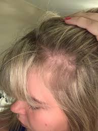3 ﻿ with this type of hair loss, known as telogen effluvium, hair loss commonly begins three to four months after a trigger (such as stress, a medical condition, or a medication change). Dorkwingduck4life