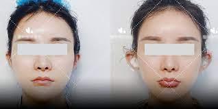 These include eye drops, pills and emerging home remedies like medical mariju. China S Cosmetic Surgery Trends Are Getting Riskier And Weirder