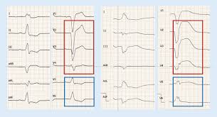 Können viele schmerzen ausstrahlen auch bis in die herzgegend,hatte ich auch schon.lass dich am besten mal richtig durchchecken,wirbelsäule,ekg u.s.w.dann kann man evtl.schon mal einiges ausschließen. Ekg Zeichen Eines Akuten Koronarsyndroms Springerlink
