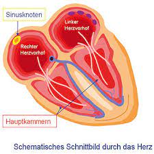 Vorhofflimmern