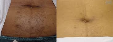 The growth of abdominal hair follows the same pattern on nearly all mammals. Laser Hair Removal Baltimore Maryland Hunt Valley Laser Hair Removal Hair Removal Laser Treatment