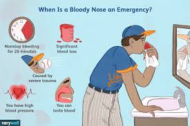 Medical School Nose Bleed Epistaxis How To Manage In 2020 Medical School Humor Sinus Headache Nose Bleeds