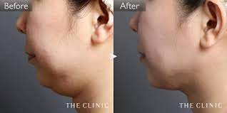 頰 顎の脂肪吸引 痩身の症例写真 the clinic ザクリニック 脂肪吸引 顎 顔