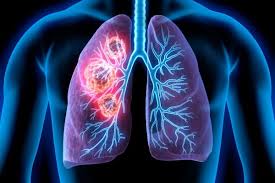 Image result for lung cancer xray