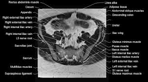 Mri Female Pelvis Anatomy Axial Image 5 Pelvis Anatomy Pelvis Rectus Abdominis Muscle