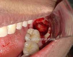 How Many Days Does It Take For Extraction Socket To Heal After Wisdom Tooth Extraction