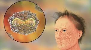 Nel regno unito un ufficiale della marina nigeriana è risultato positivo al virus del vaiolo delle scimmie. Vaiolo Delle Scimmie L Infettivologo Non Ci Sono Cure Ne Vaccini Il Mattino It