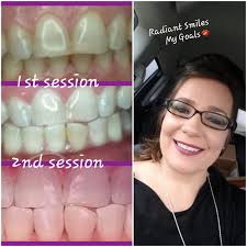 Radiant Smiles Whitening Co.