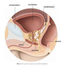 Prostaatkanker zijn cellen in de prostaat die ongecontroleerd beginnen te groeien waardoor tumoren ontstaan. Lokaal Gevorderde Prostaatkanker Alles Over Urologie