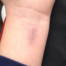 Swelling of your face, lips, tongue, or throat. Sepsis Flecken Round Gift Stock Fotos Und Bilder Getty Images Anzeichen Fur Eine Sepsis Sind Unter Anderem Fieber Schuttelfrost Unruhe Desorientierung Und Rote Flecken Auf Der Haut Astrid S Wall