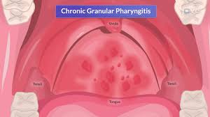 Image result for Pharyngitis