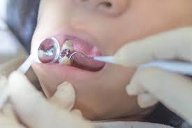 Cavities take their toll in many ways. Pros Cons Of White Fillings Vs Silver Fillings Semiahmoo Dental