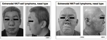 悪性リンパ腫 Malignant lymphoma (Lymphoid Malignances)