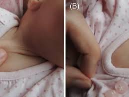 Image result for Capillary Refill