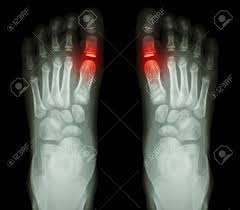 Severe rheumatoid arthritis of the wrist and hand. Rheumatoid Arthritis Gouty Arthritis X Ray Child Stock Photo Picture And Royalty Free Image Image 31911212