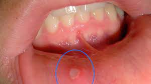 Some sores inside the mouth are usually raised and filled with fluid just like blisters. Mouth Sores Pictures Causes Types Symptoms And Treatments