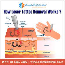 See hot celebrity videos, e! Cosmedaestheticclinic Offers You The Best Advanced Tattooremoval Techniques In Mumbai Helps You To Get Ove Aesthetic Clinic Cosmetic Surgeon Cosmetic Clinic