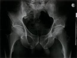 You have pain that doesn't go away in your lower back, pelvis, upper thighbones, or other bones. Malignant Bone Tumors Amboss