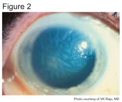 The attacks may feature stromal keratouveitis with deeper ocular structures being involved. Herpes Simplex Virus Stromal Keratitis And Endotheliitis Eyewiki