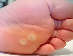 Barko's.any guesses who it might. Verruca Diagnosis Cause And Treatment London Foot And Ankle Surgery