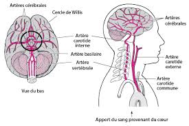 En cas d'avc, certains symptômes sont propres à la femme et, par méconnaissance, ils ne sont pas toujours associés à une attaque cérébrale. Presentation De L Accident Vasculaire Cerebral Troubles Du Cerveau De La Moelle Epiniere Et Des Nerfs Manuels Msd Pour Le Grand Public