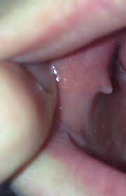 Knubbel Im Mund Denta Beaute