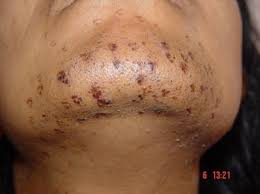 Consulting with a doctor is important before finalizing any major decisions. A Review Of The Adverse Effects Of Laser Hair Removal Springerlink