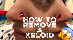 This is because of its salicylic content that is known to be used for various skin conditions. How I Removed My Nose Piercing Bump Keloid Youtube