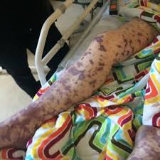 Bacterial meningitis requires rapid initiation of empiric treatment. Meningitis Teenager Shares Photos To Raise Awareness Bbc News