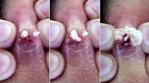 Here are some of the most amazing guinness world records ever that will make you facepalm hard. Man Finally Squeezes Spot After 20 Years Daily Mail Online