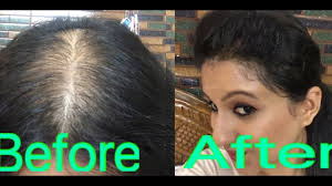 Frontal balding or receding hairline is the most common pattern of hair loss being observed in men hair transplant is found to be the only permanent treatment for receding hairline because hair that you grow with a surgery stays with you for the rest of. How To Style Your Hair In Partial Alopecia To Hide Bald Spots Youtube