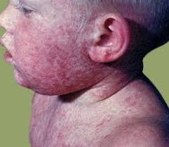 Penyakit yang belakangan ini menjadi perbinacangan hangat adalah penyakit yang disebabkan oleh virus mematikan dari genus ebolavirus. 30 Jenis Penyakit Menular Penyebab Dan Pencegahannya