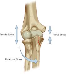 Image result for Coronoid Process Fracture