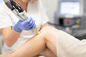 Convient à tous les types de peaux, y compris les peaux noires, metissées ou. Laser Hair Removal Lyon Cabinet Medical Foch Cabinet Medical Foch
