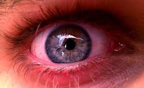 Mata merah ini mengindikasikan terjadinya masalah di mata anda, masalah tersebut bisa berupa masalah ringan hingga yang cukup serius. Mata Merah Yang Tidak Menyakitkan Eyefood