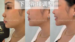 小姐姐做了无痕侧颜杀，双下巴改善了再加个下巴填充（衍生下颚线） 效果1+1大于2😍 双下巴形成有很多原因，建议配合我们的方案一步一步调整