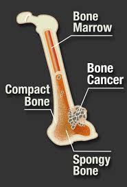 Bone pain, tenderness (especially back, ribs; Bone Multiple Myeloma Cancer Facts Symptoms Uhc Oncology