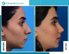 How long exactly does it take to complete a tefl course? How Long Does It Take To Recover From A Nose Surgery Ariamedtour