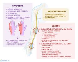 It happens because of pressure on your median nerve, which runs the length of your arm, goes through a passage in your wrist called the carpal tunnel, and. Ulnar Nerve Entrapment What Is It Symptoms Causes Treatment And More Osmosis