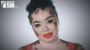 El vitiligo está asociado a problemas de tiroides y otras enfermedades