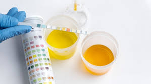 Presence Of Pus Cell By Urine Routine Examination | Download Table