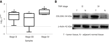 Stages are numbers used to describe how far a cancer has advanced and where it has spread in the body. High Plasma Levels Of Col10a1 Are Associated With Advanced Tumor Stage In Gastric Cancer Patients