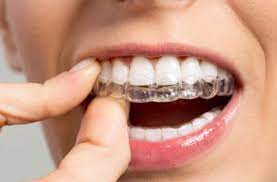 Nov 16, 2017 · your retainer may have metal wires that hold your teeth in alignment while the bones and gums heal. How Long You Have To Wear Invisalign And Why You Need To The Bachmayer Orthodontic Clinic Blogthe Bachmayer Orthodontic Clinic Blog