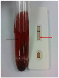 In any case when the test results show you are pregnant but there is no factual pregnancy, you are advised to have a full medical examination to precisely identify the reason of the above and, if applicable, get the treatment. False Positive Urine Pregnancy Test In A Woman With Adenomysosis The American Journal Of Emergency Medicine