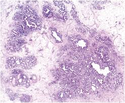 A hamartoma (from greek hamartion bodily defect) is a benign (noncancerous) tumorlike malformation made up of an abnormal mixture of cells and tissues found in areas of the body where growth occurs. Seromucinous Hamartoma Case 56 Pearls And Pitfalls In Head And Neck Pathology