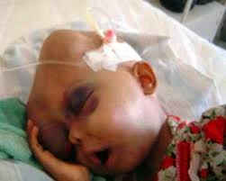 Many of the general symptoms of blood cancers can also be caused by other conditions, so it is important to be evaluated by a healthcare professional to determine the cause of these symptoms. Recognizing Symptoms Of Leukemia In Children Parents Must Detect Early Netral News