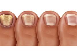 Image result for onychomycosis