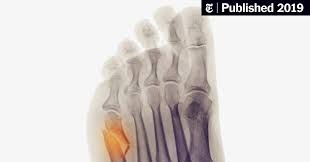 If you are concerned about any changes you experience, please talk with your doctor. We Broke The Same Bone My Recovery Was A Breeze Hers An Ordeal Why The New York Times