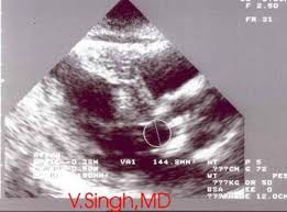 Echocardiography: An Overview - Part Iii